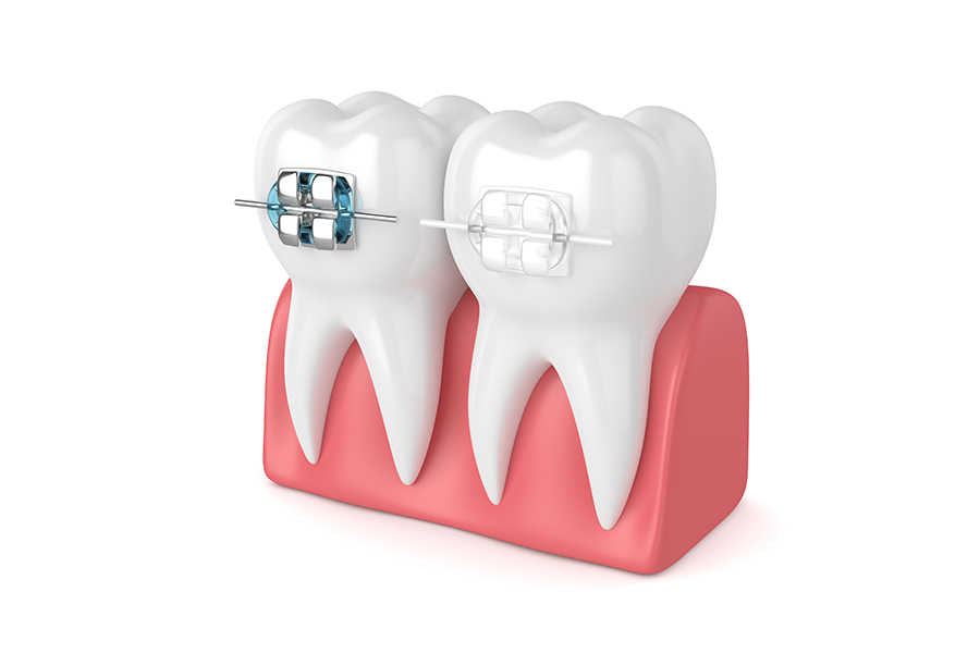 部分矯正の特徴