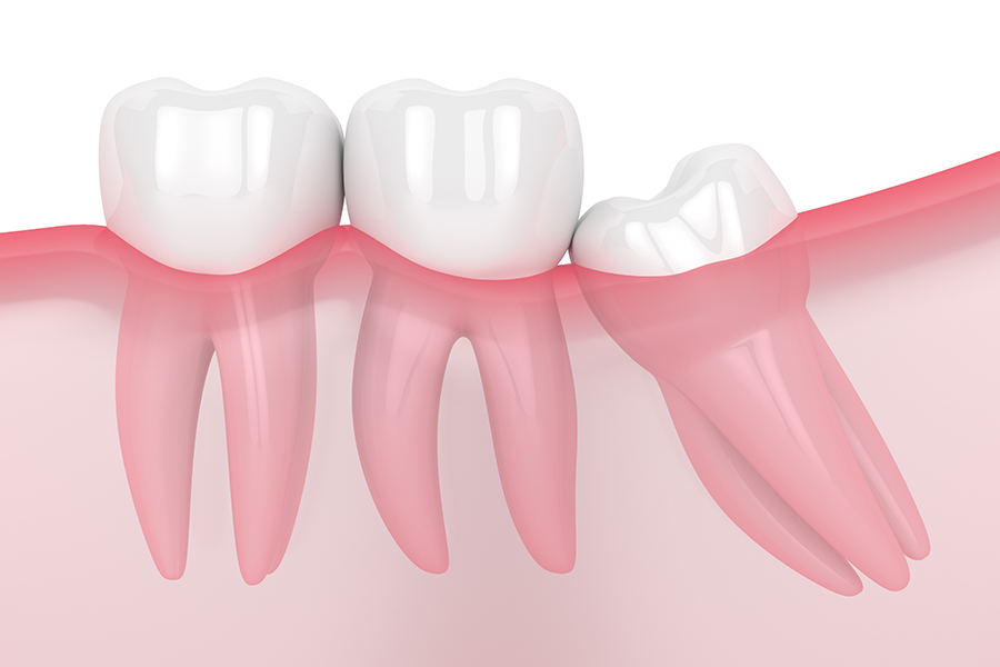 親知らずについて