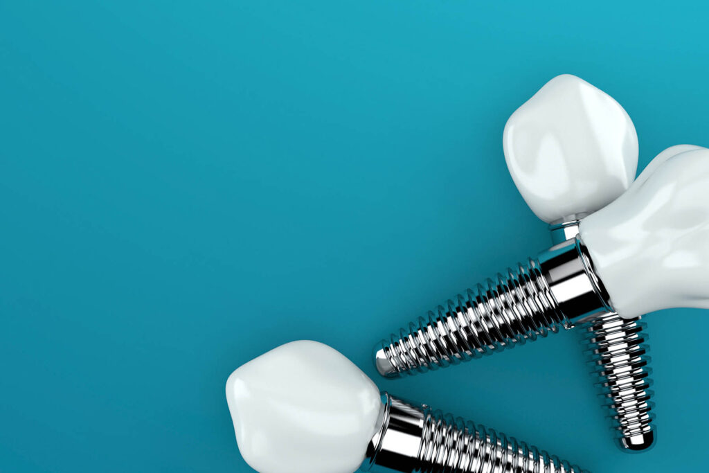 インプラント寿命